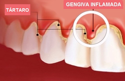 Sinais de gengivite — gengiva inflamada