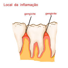 Tratamento de gengivite com laser em Campinas