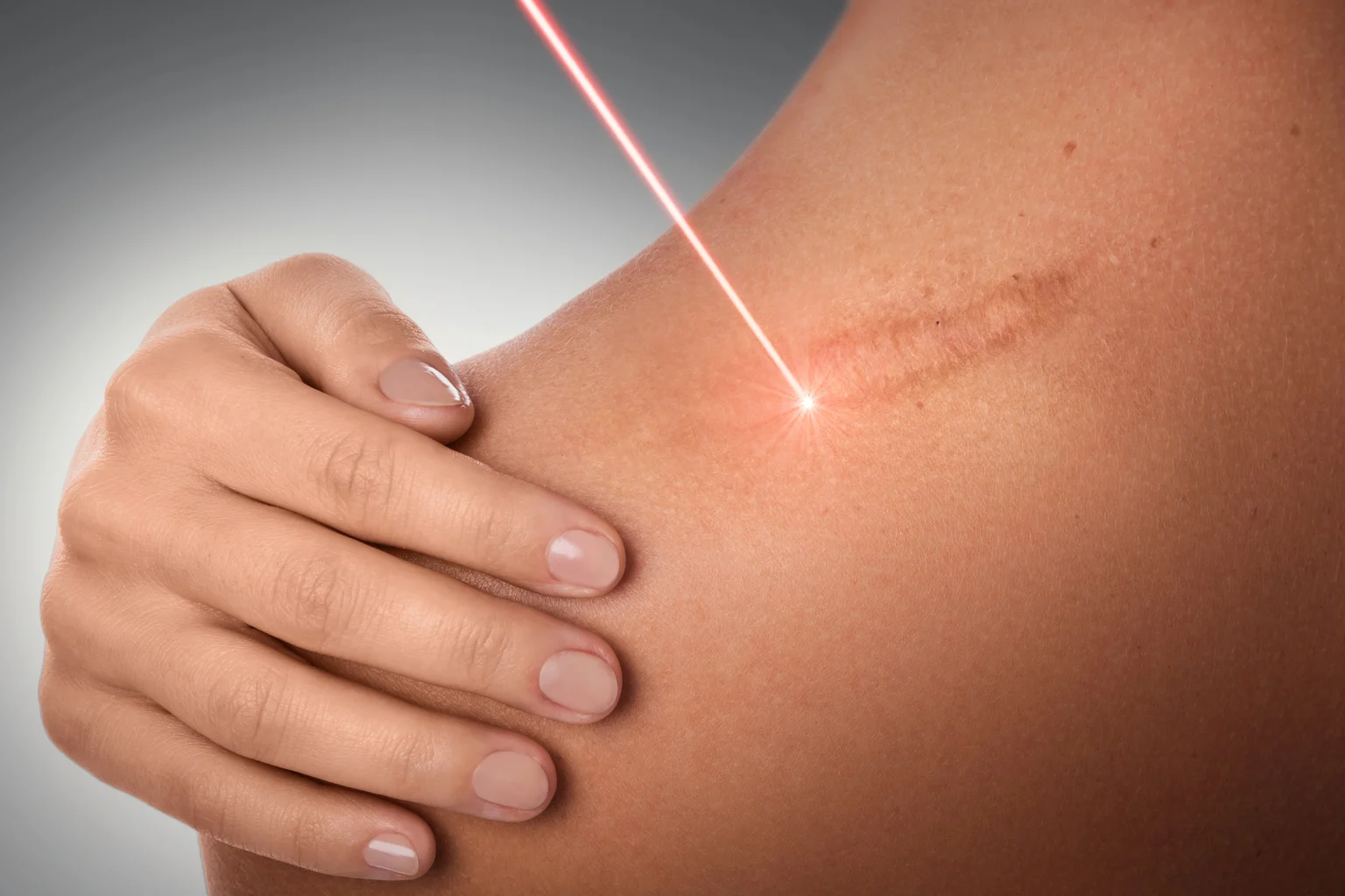 Laser acupuntura em Campinas — tratamento sem agulhas