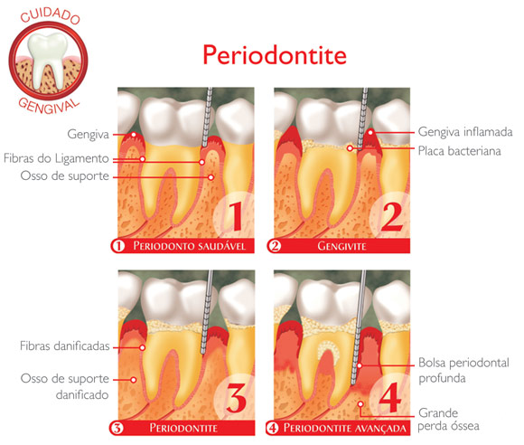 Periodontite — perda óssea e comprometimento dos tecidos de suporte