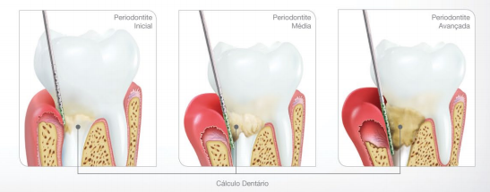 Tratamento de periodontite com laser em Campinas